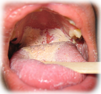 Candidiasis orofaringea pseudomembranosa