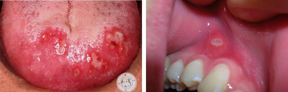 dentista genova afte dentista genova afte