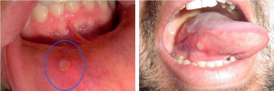 afte dentista genova afte dentista genova
