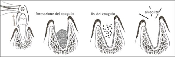 alveolite dentista genova alveolite dentista genova