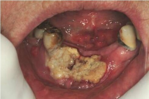dentista genova bifosfonati dentista genova bifosfonati
