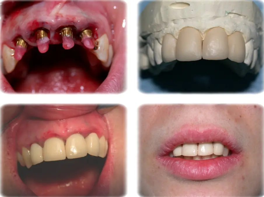 carico immediato impianti dentali carico immediato impianti dentali