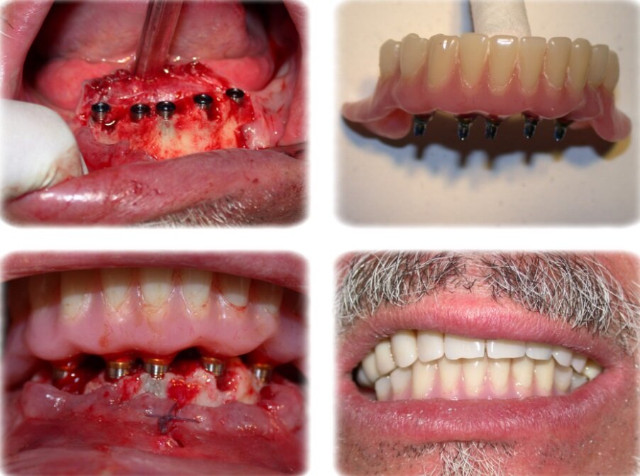 carico immediato arcata dentale carico immediato arcata dentale