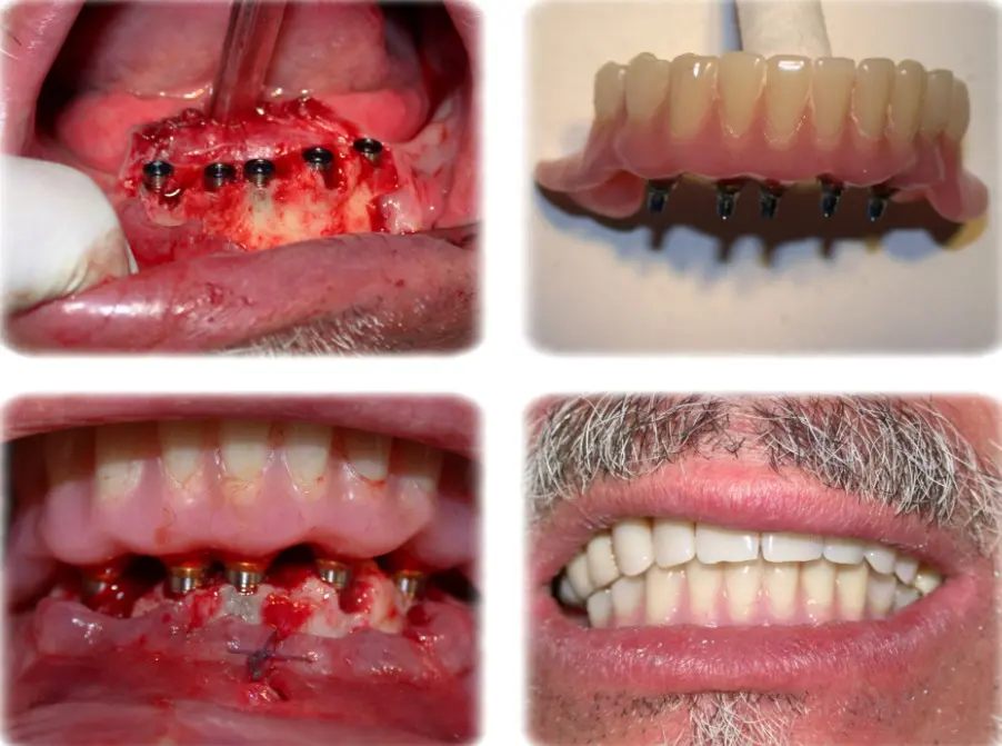 carico immediato arcata dentale carico immediato arcata dentale