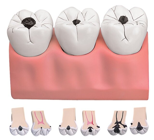 dentista genova carie dentista genova carie