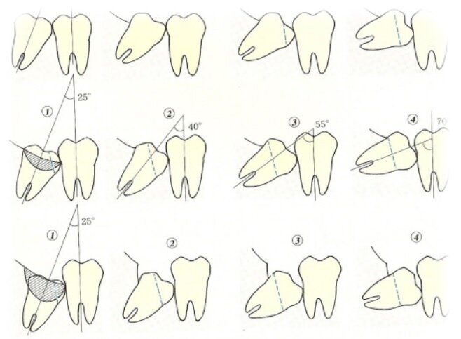 estrazioni dente giudizio