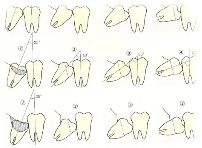 estrazioni dente giudizio estrazioni dente giudizio