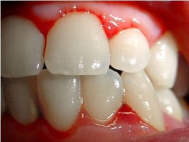 dentista genova gengivite dentista genova gengivite