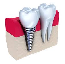 implantologia denti genova implantologia denti genova