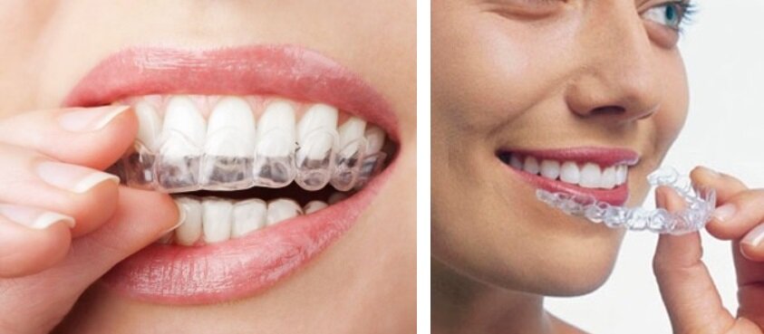 invisalign ortodonzia invisibile