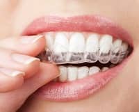 invisalign dentista genova invisalign dentista genova