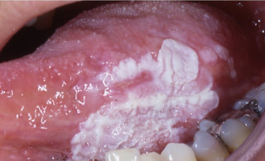 dentista genova leucoplachia dentista genova leucoplachia