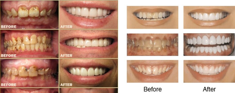 faccette dentali faccette dentali