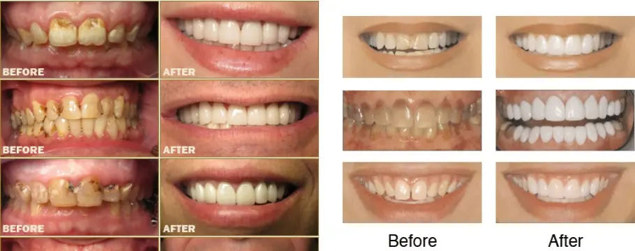faccette dentali faccette dentali