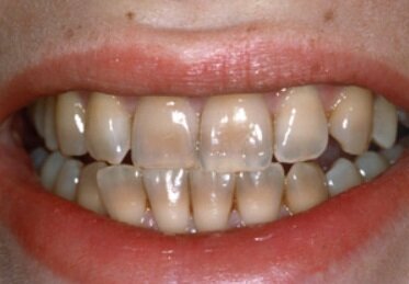 dentista genova macchie denti dentista genova macchie denti