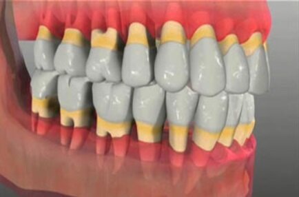 piorrea dentista genova piorrea dentista genova